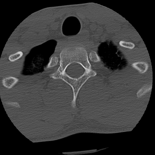 Apical pneumothorax on cervical spine CT (Radiopaedia 45343-49368 Axial bone window 86).jpg