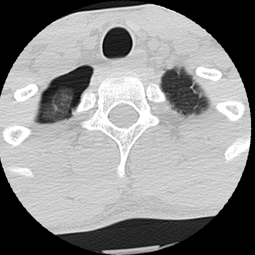 File:Apical pneumothorax on cervical spine CT (Radiopaedia 45343-49368 Axial lung window 6).jpg