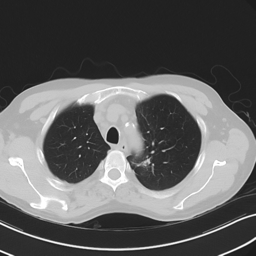 File:Apical pulmonary metastasis (Radiopaedia 46338-50754 Axial non-contrast 17).png