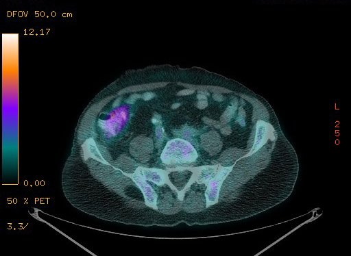 Appendiceal adenocarcinoma complicated by retroperitoneal abscess (Radiopaedia 58007-65041 Axial PET-CT 156).jpg