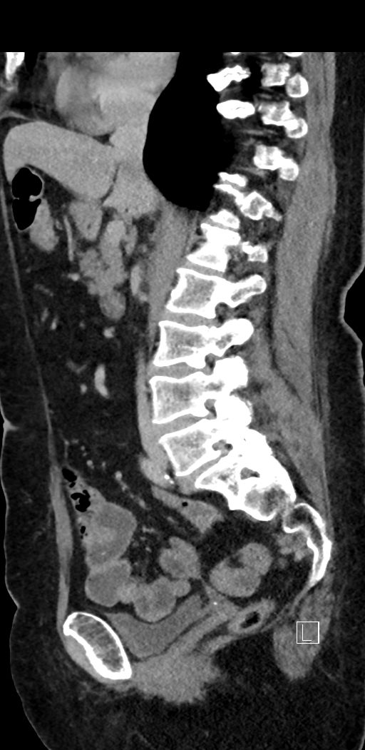 Appendiceal hemorrhage (Radiopaedia 70830-81025 Sagittal C+ delayed 52).jpg