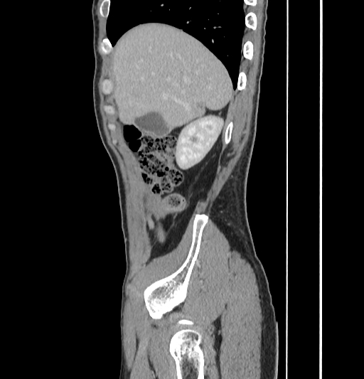 Appendiceal mucinous adenocarcinoma (Radiopaedia 66605-75922 C 11).jpg
