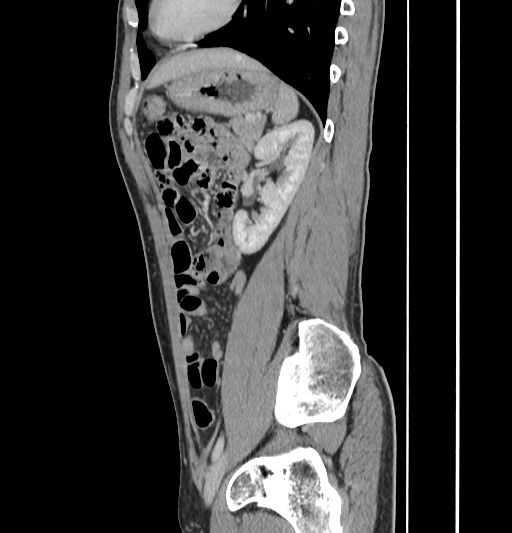 Appendiceal mucinous adenocarcinoma (Radiopaedia 66605-75922 C 48).jpg
