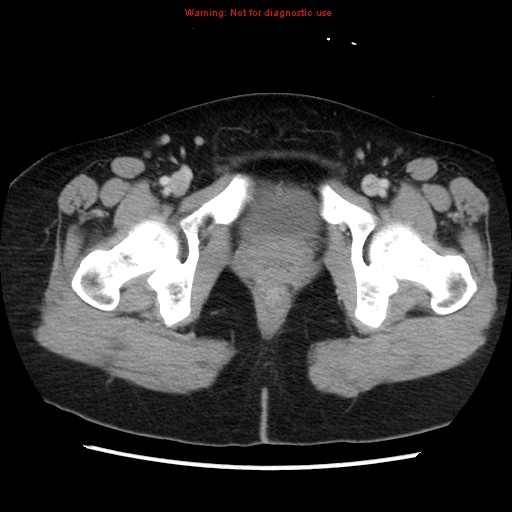 Appendiceal mucinous cystadenoma (Radiopaedia 8263-9111 Axial liver window 80).jpg
