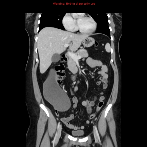 Appendiceal mucinous cystadenoma (Radiopaedia 8263-9111 B 30).jpg