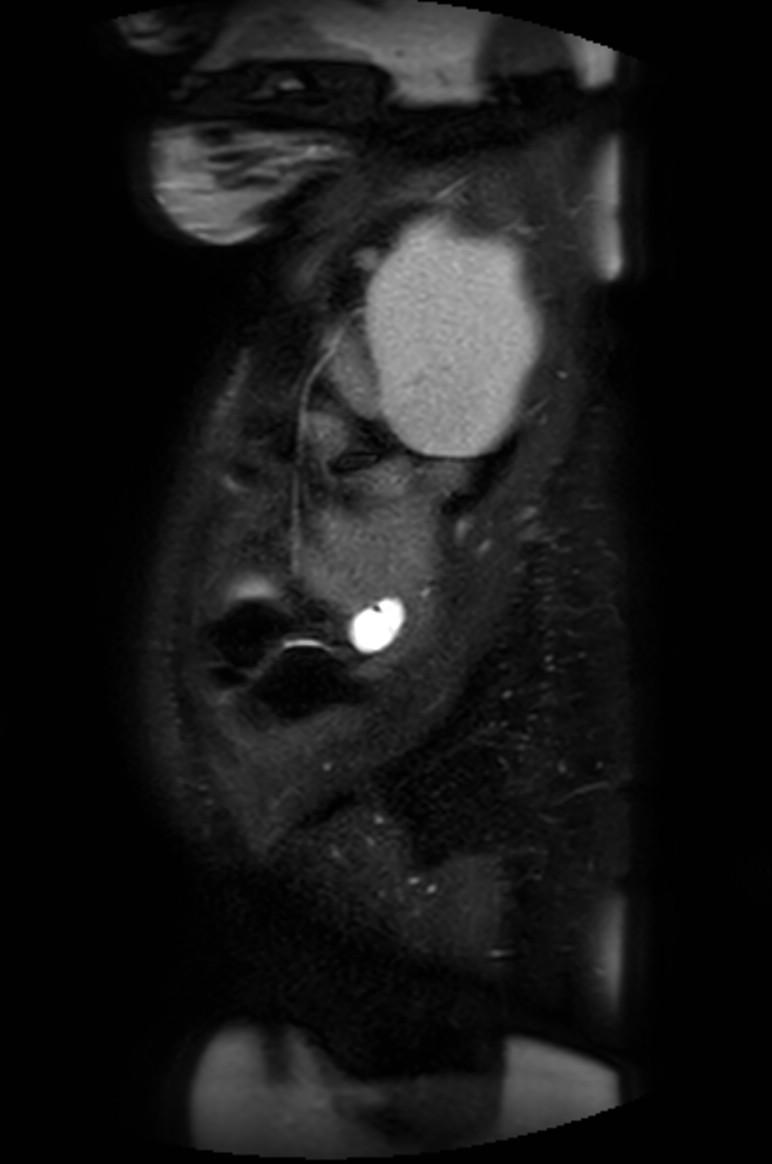 Appendicitis in gravida (MRI) (Radiopaedia 89433-106395 Sagittal T2 SPAIR 6).jpg