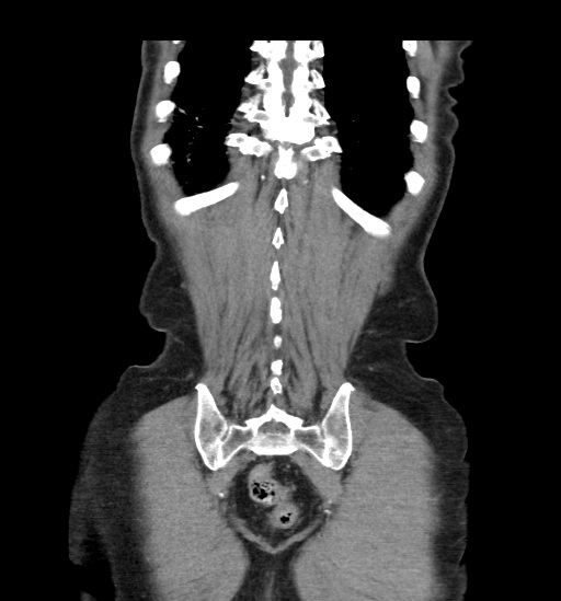 Appendicitis with localized perforation and abscess formation (Radiopaedia 49035-54130 B 44).jpg