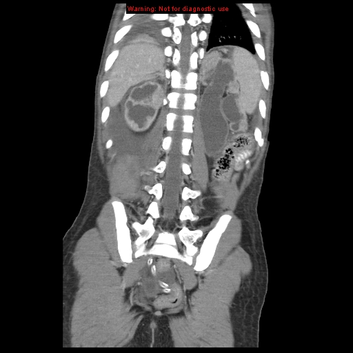 File:Appendicitis with phlegmon (Radiopaedia 9358-10046 B 54).jpg