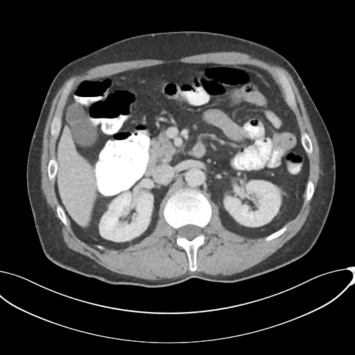 Appendicitis with thickening of the terminal ileum (Radiopaedia 42432-45550 A 37).png
