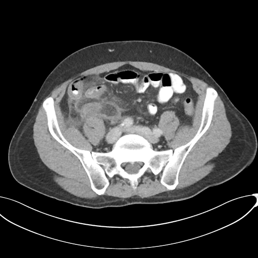 Appendicitis with thickening of the terminal ileum (Radiopaedia 42432-45550 A 71).png