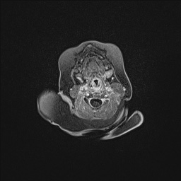 Aqueductal stenosis (Radiopaedia 73974-84802 Axial T1 C+ 11).jpg