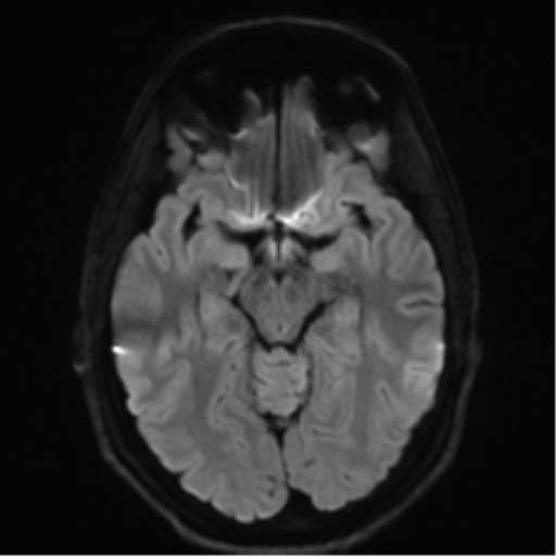 Arachnoid cyst - cerebellopontine angle (Radiopaedia 59689-67083 Axial DWI 51).png