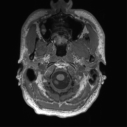 File:Arachnoid cyst with subdural hematoma (Radiopaedia 85892-101743 Axial T1 10).png