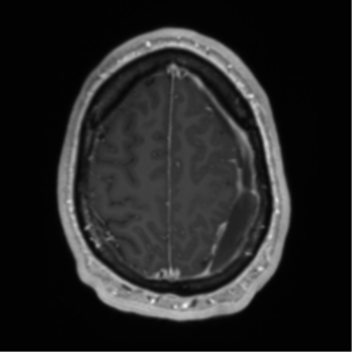 Arachnoid cyst with subdural hematoma (Radiopaedia 85892-101743 Axial T1 C+ 69).png