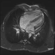 File:Arrhythmogenic right ventricular cardiomyopathy (Radiopaedia 57972-64966 A 12).jpg