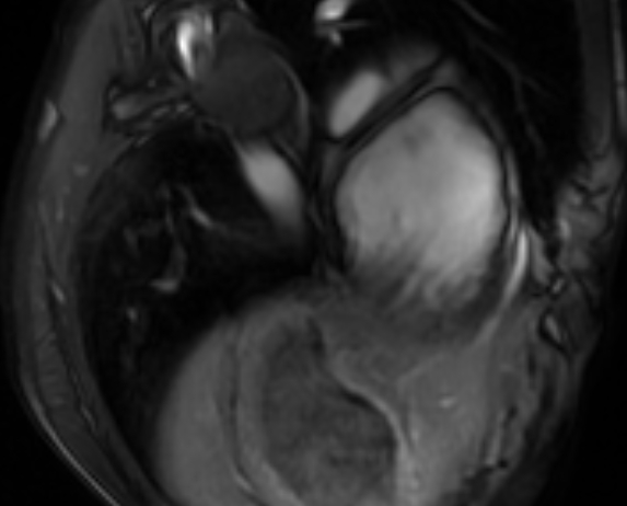 Arrhythmogenic right ventricular cardiomyopathy (Radiopaedia 69564-79464 4ch cine 142).jpg