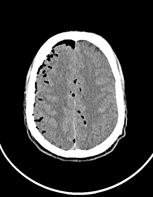 Arrow injury to the brain (Radiopaedia 72101-82607 Axial non-contrast 82).jpg