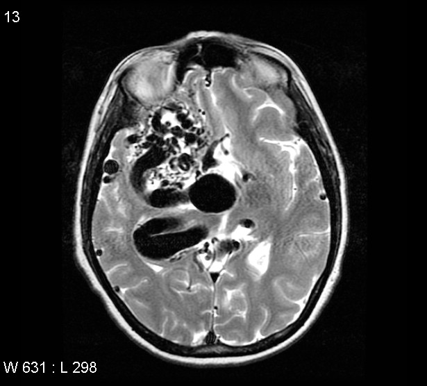 File:Arteriovenous malformation - cerebral (Radiopaedia 4000-6538 Axial T2 7).jpg