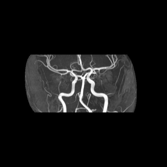 File:Artery of Percheron infarct (Radiopaedia 40966-43676 G 31).jpg