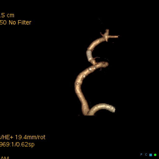 File:Artifactual basilar artery stenosis due to metallic stent (Radiopaedia 31206-31923 C 5).jpg