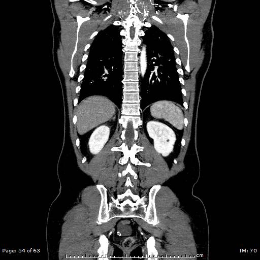File:Ascending aortic aneurysm (Radiopaedia 50086-55404 B 54).jpg