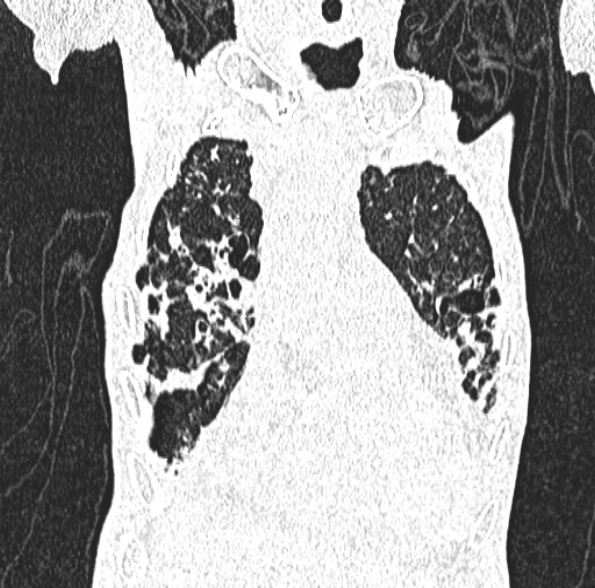 Aspergilloma- with Monod sign (Radiopaedia 44737-48532 Coronal lung window 163).jpg