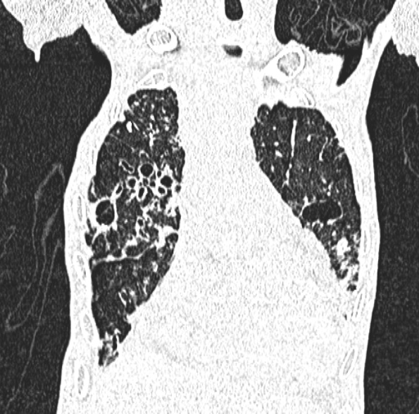 File:Aspergilloma- with Monod sign (Radiopaedia 44737-48532 Coronal lung window 172).jpg