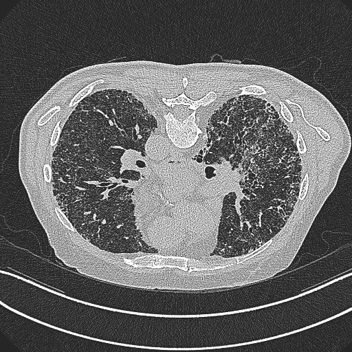 File:Aspergilloma on background pulmonary fibrosis (Radiopaedia 60942-68757 Axial lung window 9).jpg
