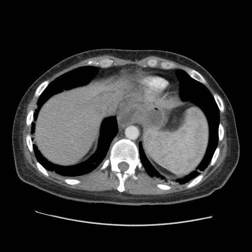 File:Aspiration pneumonia secondary to laparoscopic banding (Radiopaedia 18345-18183 A 45).jpg