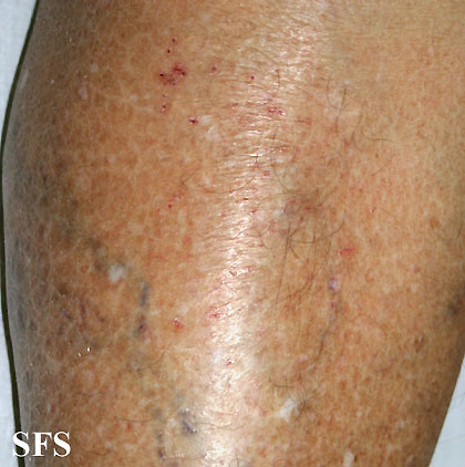 Asteatotic Dermatitis (Dermatology Atlas 3).jpg