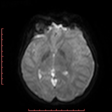 Astroblastoma (Radiopaedia 74287-85162 Axial DWI 46).jpg