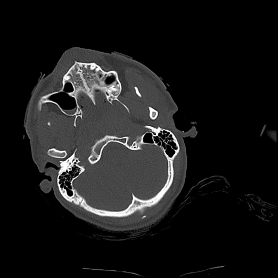 Atlanto-occipital dissociation (Traynelis type 1), C2 teardrop fracture, C6-7 facet joint dislocation (Radiopaedia 87655-104061 Axial bone window 8).jpg