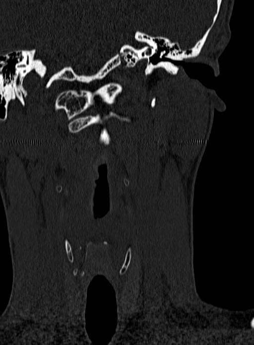 Atlantoaxial subluxation (Radiopaedia 44681-48450 Coronal bone window 5).jpg