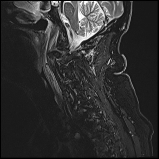File:Atlas (type 3b subtype 1) and axis (Anderson and D'Alonzo type 3, Roy-Camille type 2) fractures (Radiopaedia 88043-104610 Sagittal STIR 2).jpg