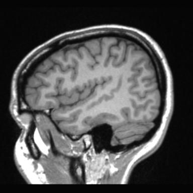 File:Atretic encephalocoele with inferior vermis hypoplasia (Radiopaedia 30443-31108 Sagittal T1 25).jpg