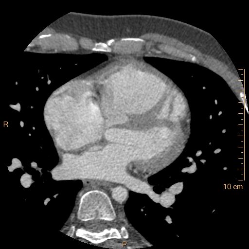 Atrial septal defect (upper sinus venosus type) with partial anomalous pulmonary venous return into superior vena cava (Radiopaedia 73228-83961 A 135).jpg
