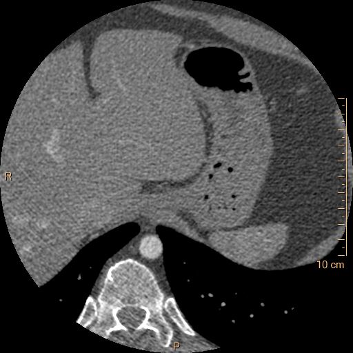 File:Atrial septal defect (upper sinus venosus type) with partial anomalous pulmonary venous return into superior vena cava (Radiopaedia 73228-83961 A 289).jpg