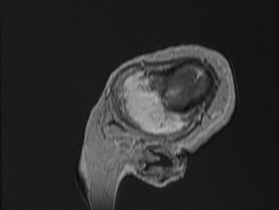 Atypical meningioma (Radiopaedia 62985-71406 Sagittal T1 C+ 100).jpg