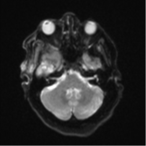 File:Atypical meningioma (WHO Grade II) (Radiopaedia 54742-60981 Axial DWI 7).png