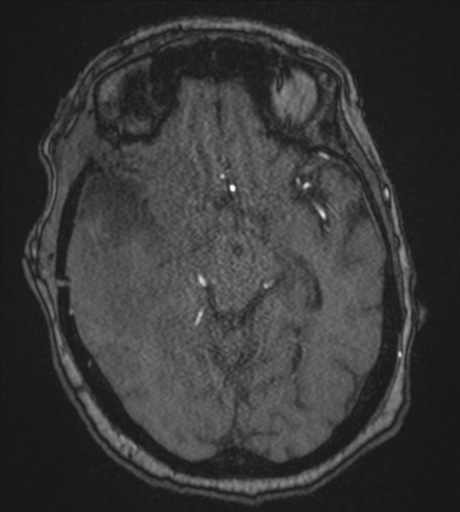 Atypical meningioma (WHO Grade II) (Radiopaedia 54742-60981 Axial MRA 42).png