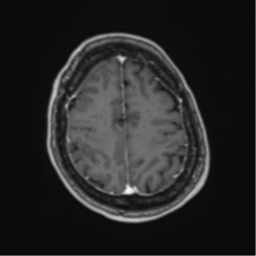 Atypical meningioma (WHO Grade II) (Radiopaedia 54742-60981 Axial T1 C+ 56).png