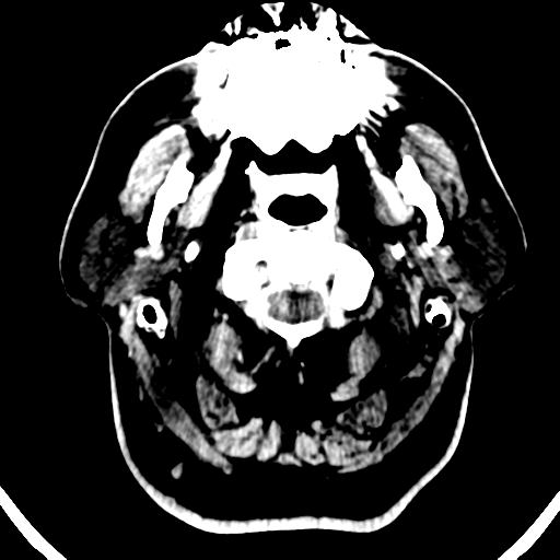 File:Atypical meningioma (WHO grade II) with brain invasion (Radiopaedia 57767-64728 Axial C+ 56).png