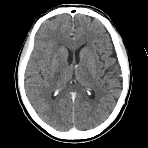 Atypical meningioma (WHO grade II) with osseous invasion (Radiopaedia 53654-59715 Axial C+ delayed 29).png