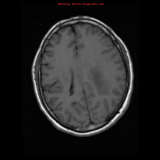 File:Atypical meningioma - grade II (Radiopaedia 13303-13305 Axial T1 14).jpg