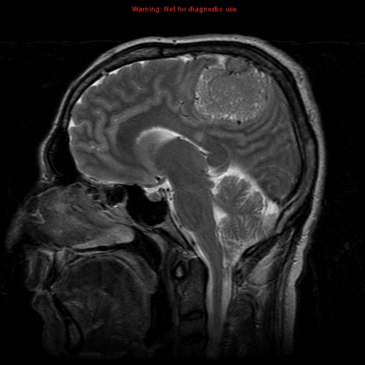 File:Atypical meningioma - grade II (Radiopaedia 13303-13305 Sagittal T2 11).jpg