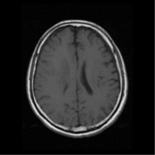 File:Atypical meningioma with skull invasion (Radiopaedia 34357-35648 Axial T1 14).png