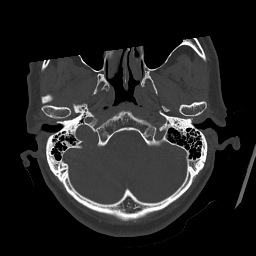 Atypical meningioma with skull invasion (Radiopaedia 34357-35649 Axial bone window 15).png