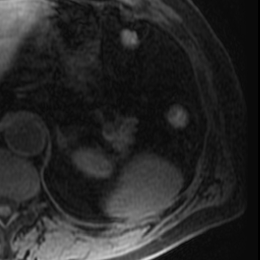 File:Atypical renal cyst on MRI (Radiopaedia 17349-17046 Axial T1 fat sat 3).jpg
