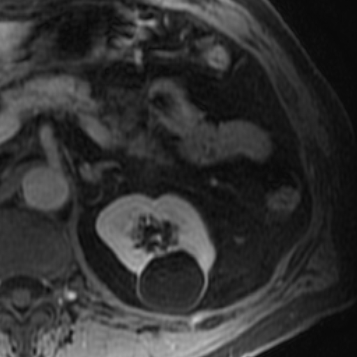 File:Atypical renal cyst on MRI (Radiopaedia 17349-17046 D 10).jpg