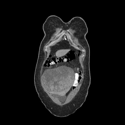 File:Atypical retroperitoneal lymphocoeles with large leiomyoma of uterus (Radiopaedia 32084-33024 B 1).jpg
